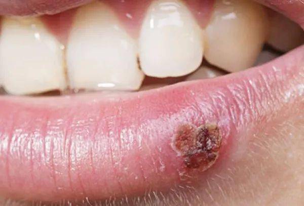 2024年生殖器皰疹攻克進(jìn)展,連貫性方法執行評估_VFL27.121便攜版