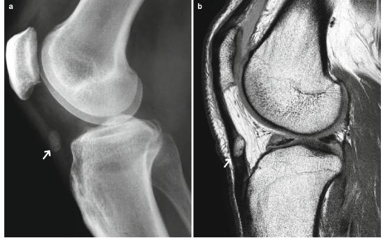 髕腱炎成為醫學(xué)焦點(diǎn)，從幕后走向舞臺中央的最新進(jìn)展