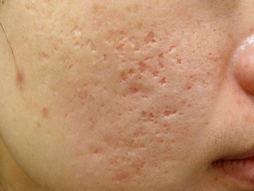 最新痘坑撫平神器，科技重塑肌膚之美，自信生活從此開(kāi)始