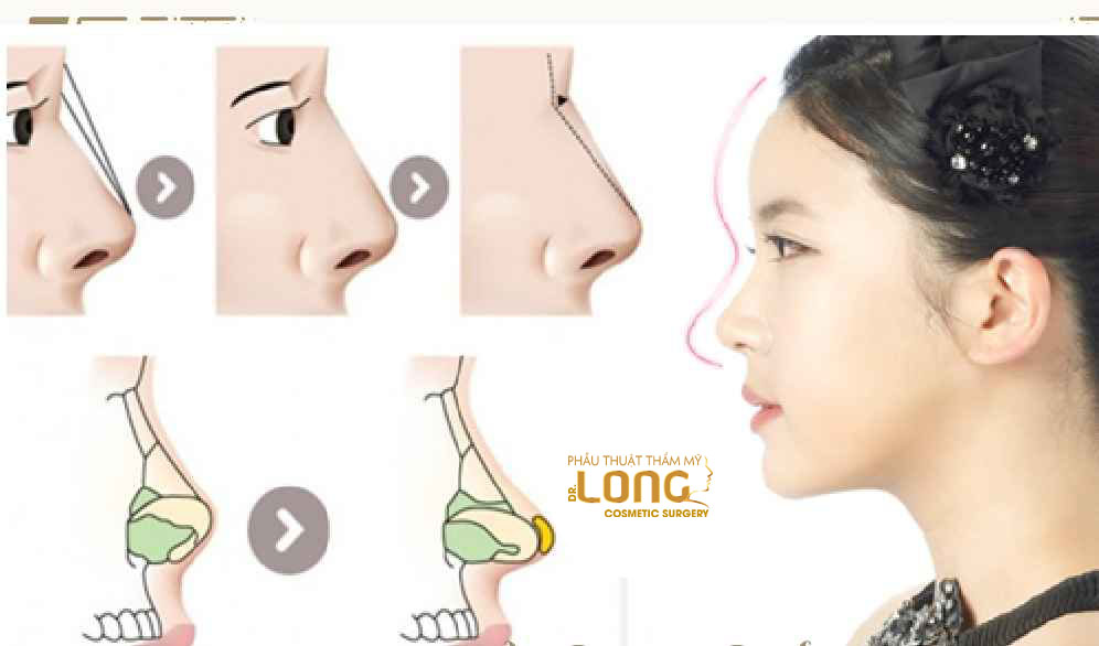 最新鼻整形技術(shù)重塑自信，煥發(fā)新生之美